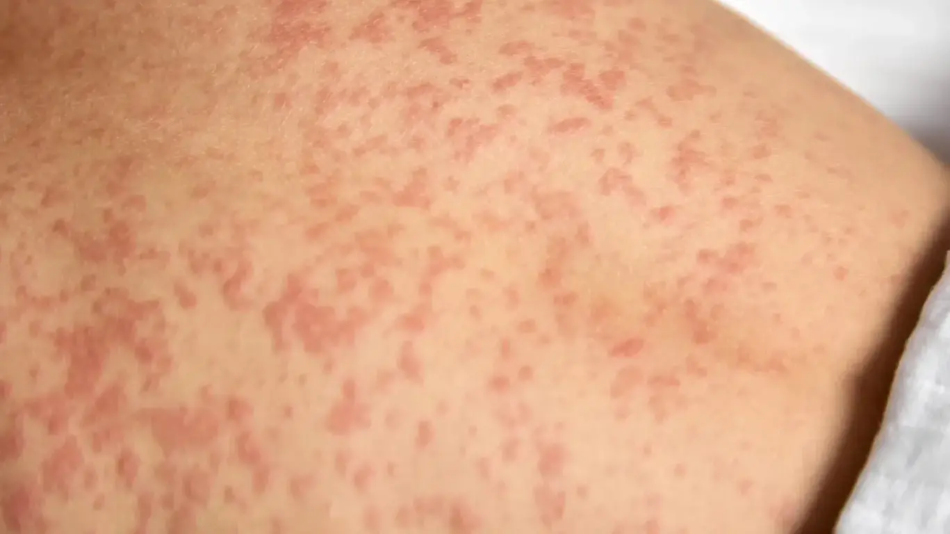 Community urged to check measles vaccination status